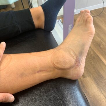 スポーツ障害part2