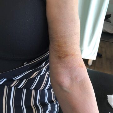 日常生活での怪我